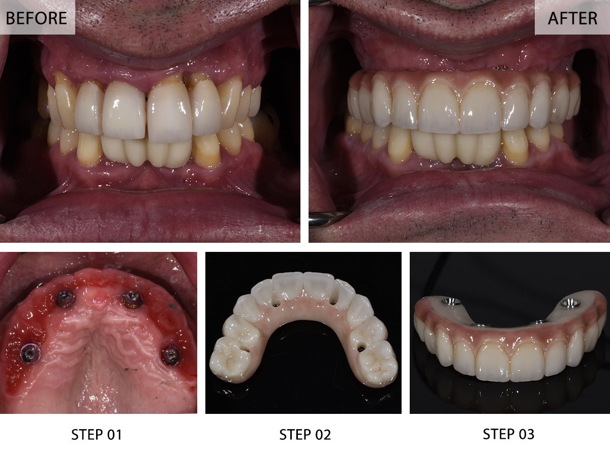 All on 4 Dental Implants Transformation
