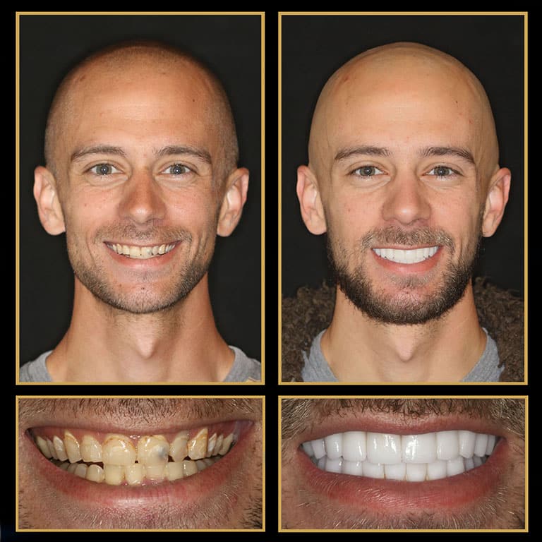 Dental Implant Before After