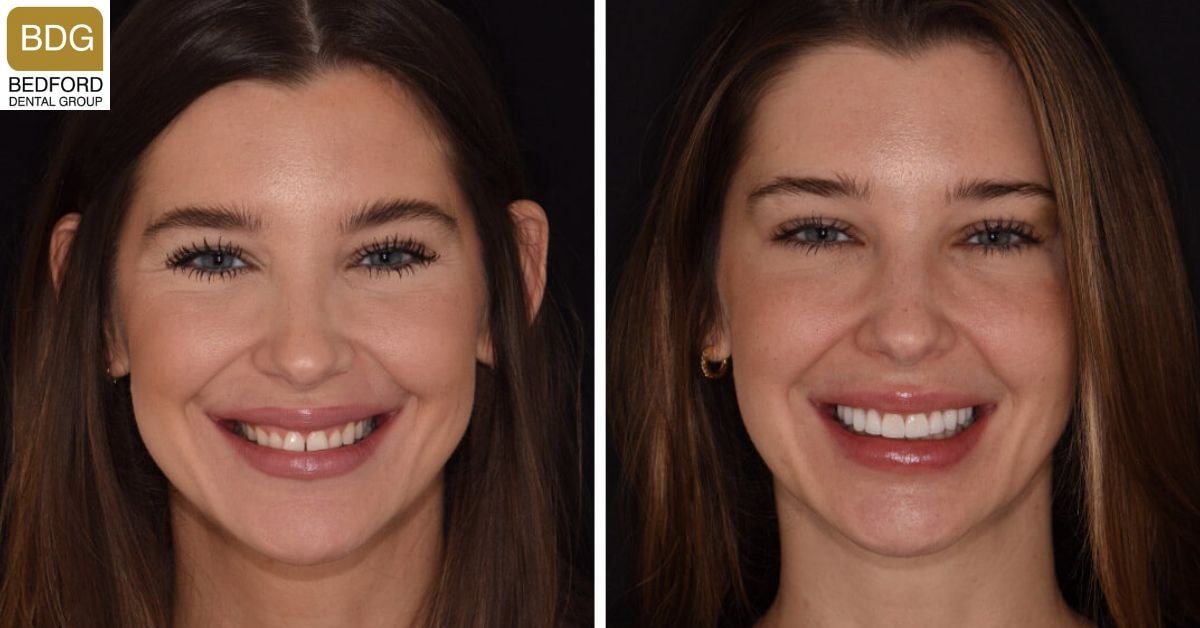 No-Prep Veneers Before and After